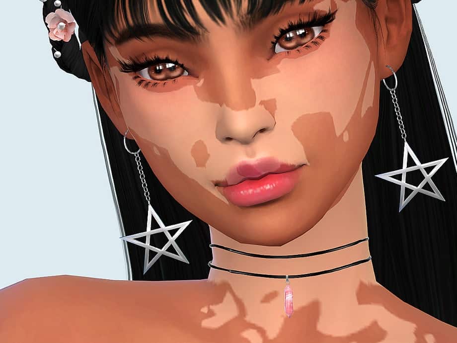 Saruin Vitiligo