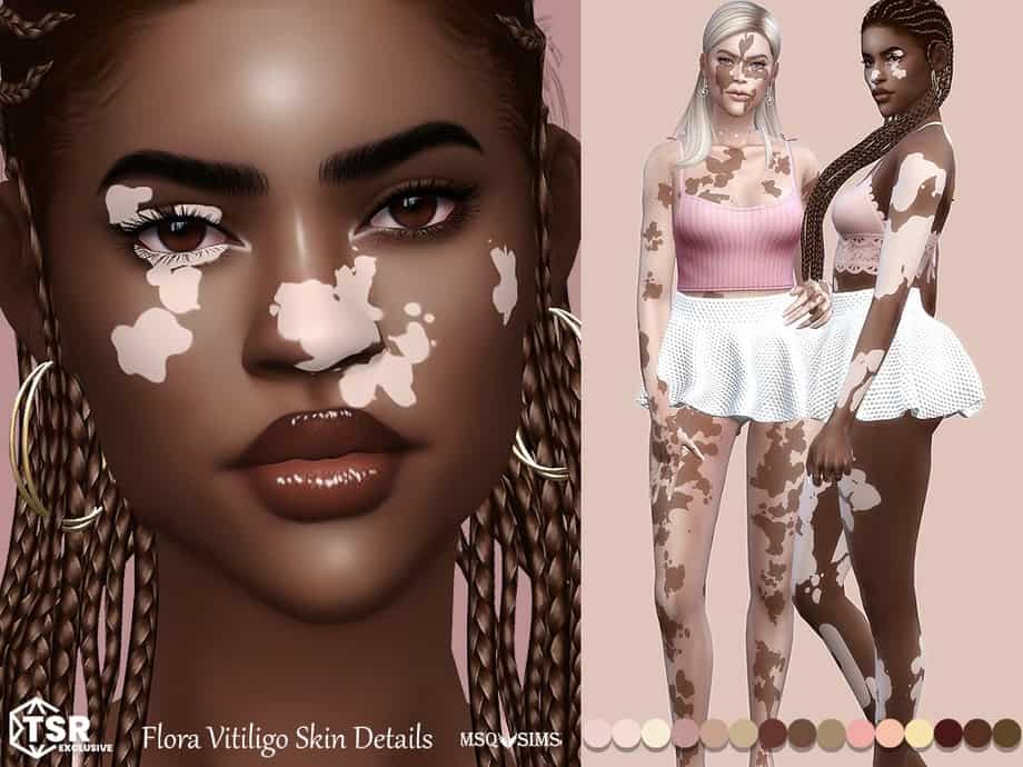 Flora Vitiligo Skin Details