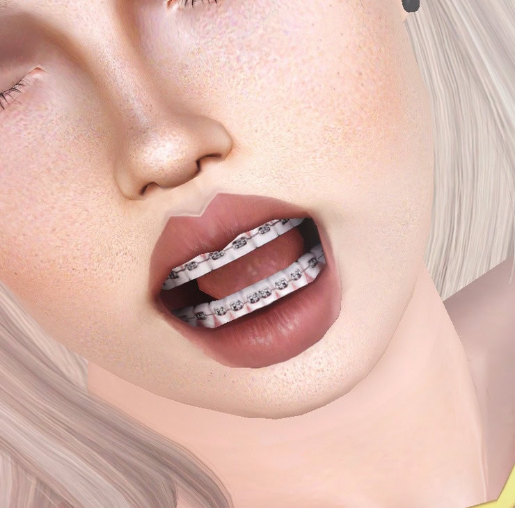 Teeth With Braces