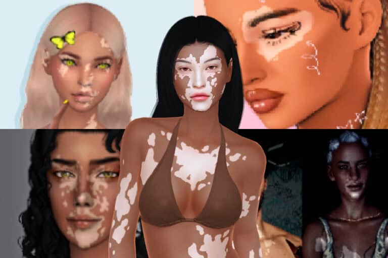 30+ Must-Have Sims 4 Vitiligo CC for Beautiful Skin Details and More Realistic Gameplay